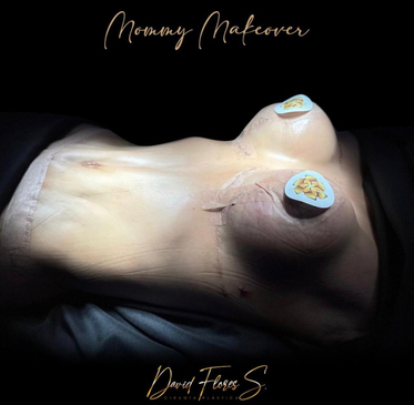 Slider image (8) Dr. David Flores Soto - DFS Plastic Surgery